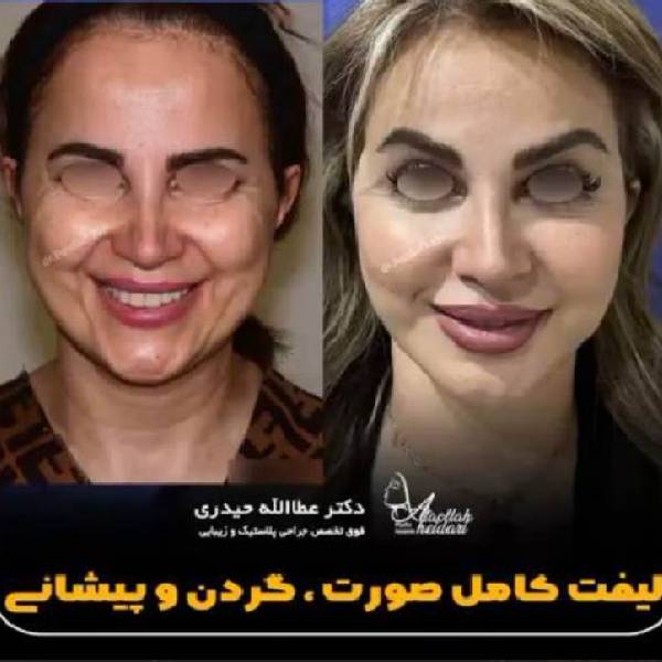 کلوئید لیفت صورت