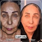 گوشت اضافه بعد از لیفت صورت