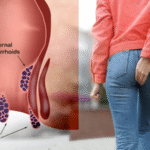 درمان قطعی بواسیر با لیزر؛ پایان دردهای همیشگی در بیماری های نشیمنگاهی